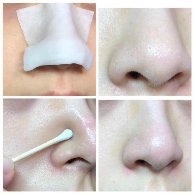 [Chính Hãng] Dung Dịch Ủ Mụn Đầu Đen Medi-peel Extra Super 9 Hàn Quốc | BigBuy360 - bigbuy360.vn