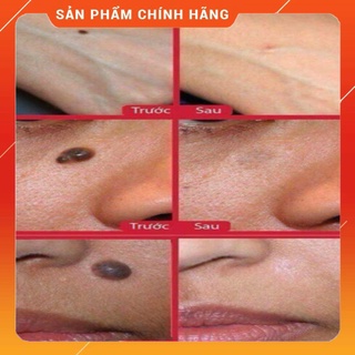 Tẩy Mụn Ruồi Nga