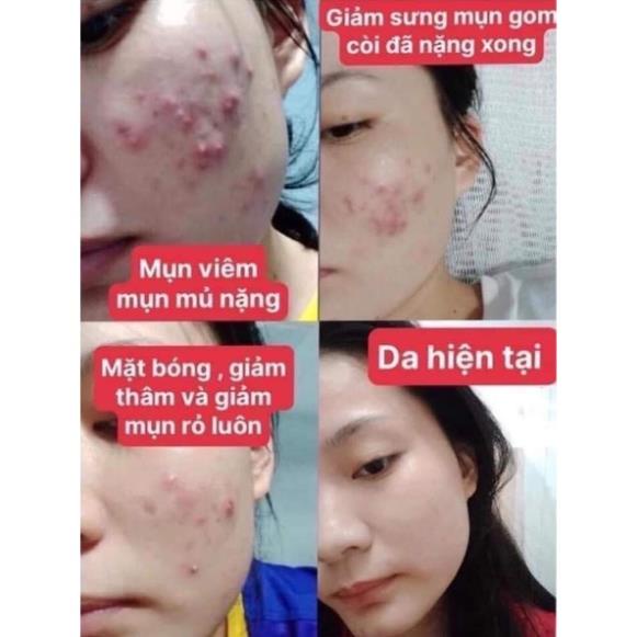 COMBO TOÀN DIỆN CHO DA HẾT MỤN. HẾT THÂM ~ COMBO DIẾP CÁ ,