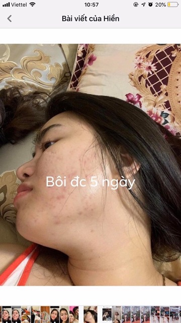 KEM MỤN BAI CAO JI giảm mụn, giảm nhờn, kiềm dầu 10g | BigBuy360 - bigbuy360.vn