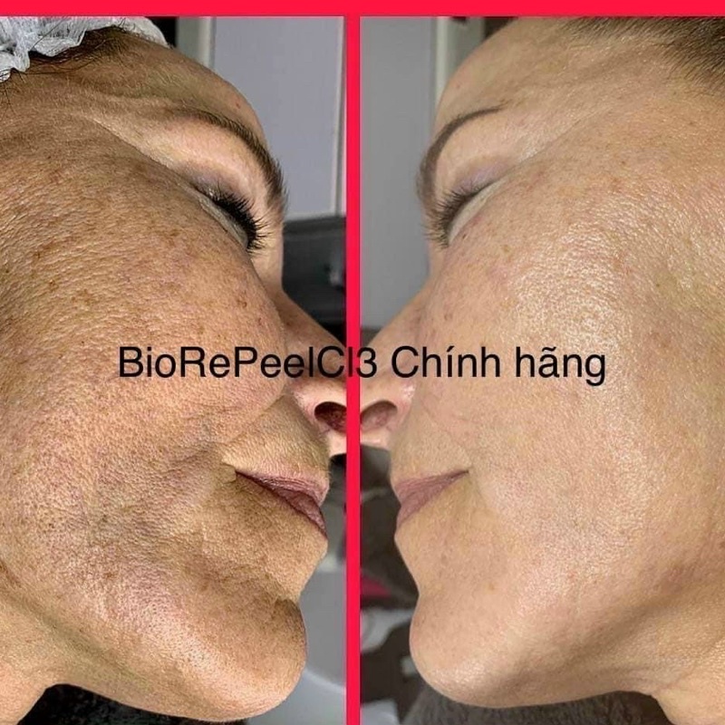 Tách lẻ 1 ống peel BioRepeelCL3 ( Hàng chính hãng )