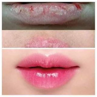 Dưỡng hồng,làm mềm môi (ủ môi)