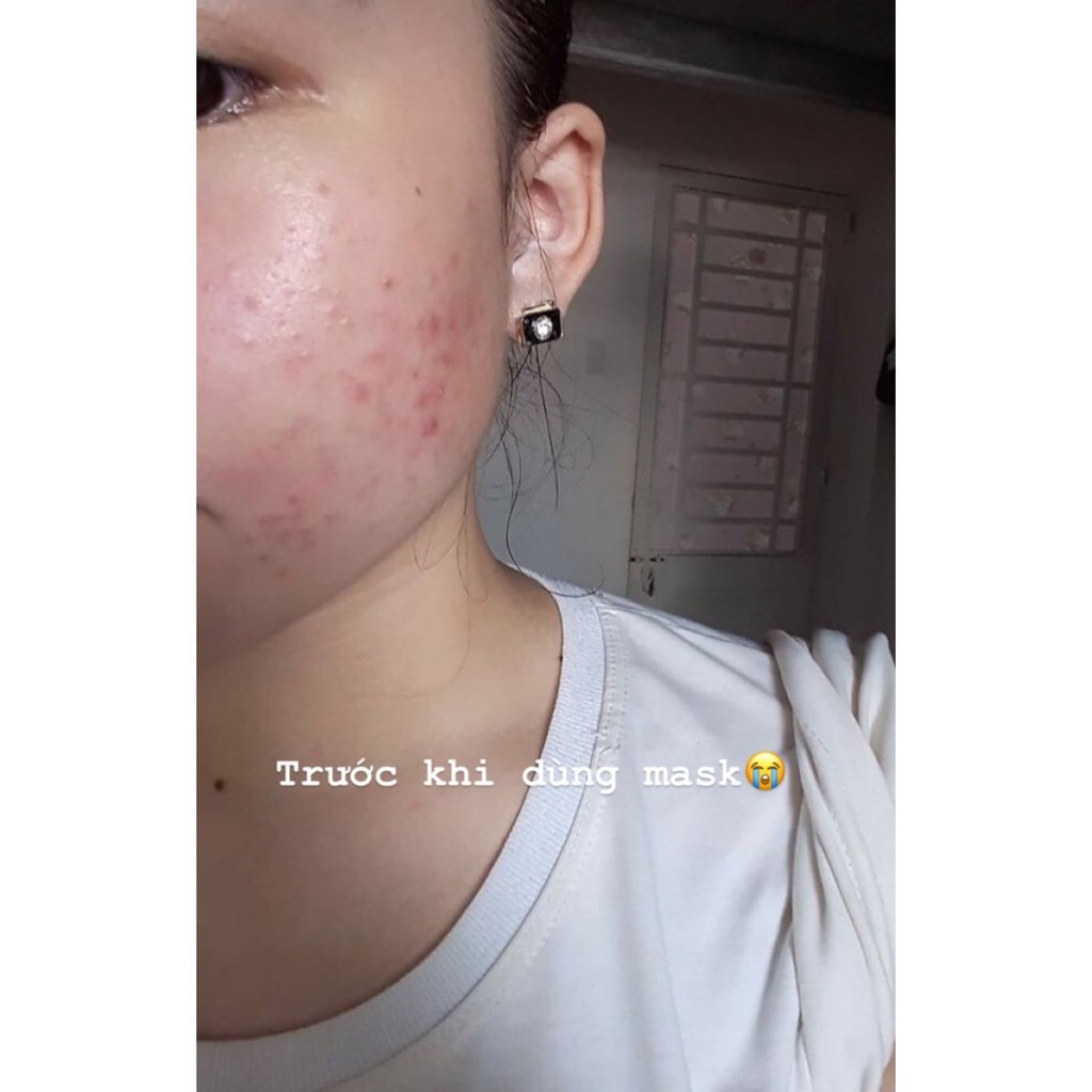 ( TOP SẢN PHẨM KIỂM SOÁT MỤN ) MẶT NẠ ĐẨY MỤN HIMALAYA Handmade | BigBuy360 - bigbuy360.vn