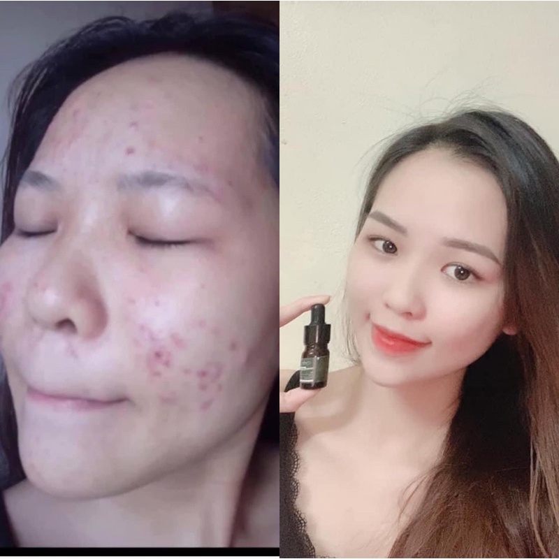 Serum khổ qua mướp đắng Lim giảm mụn mờ thâm nám hiệu quả