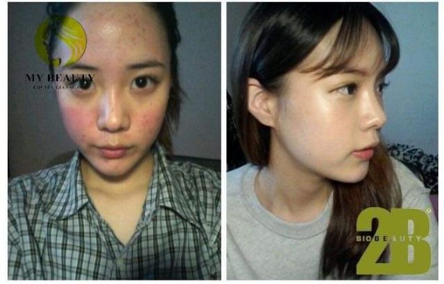 (TẶNG ĐÈN NẾN) Tảo Bỉ 2B Bio Peeling - Thay Da Sinh Học, Nâng Cơ, Trẻ Hóa | BigBuy360 - bigbuy360.vn