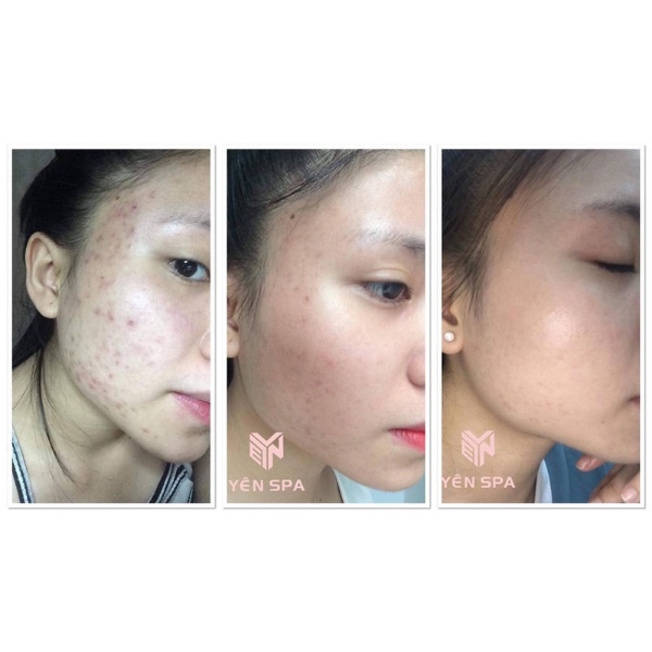 Siêu vi tảo, siêu vi kim, tảo nano tox peel dr pluscell (1 cặp)