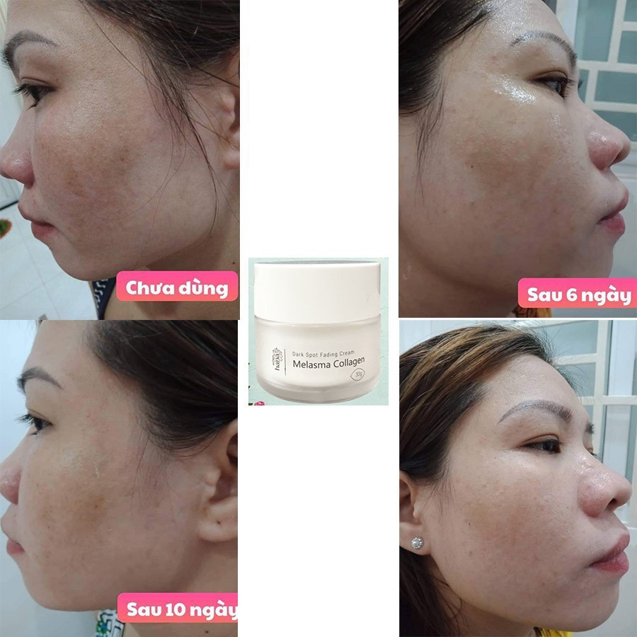 Kem Dưỡng Da Nám Riori Hana Melasma Collagen Cream 30g - Mờ Nám Thâm Sạm Ngăn Ngừa Lão Hóa