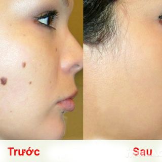 Chấm Nốt Rùi Tàn Nhang - Mụn Cóc Mụn Thịt