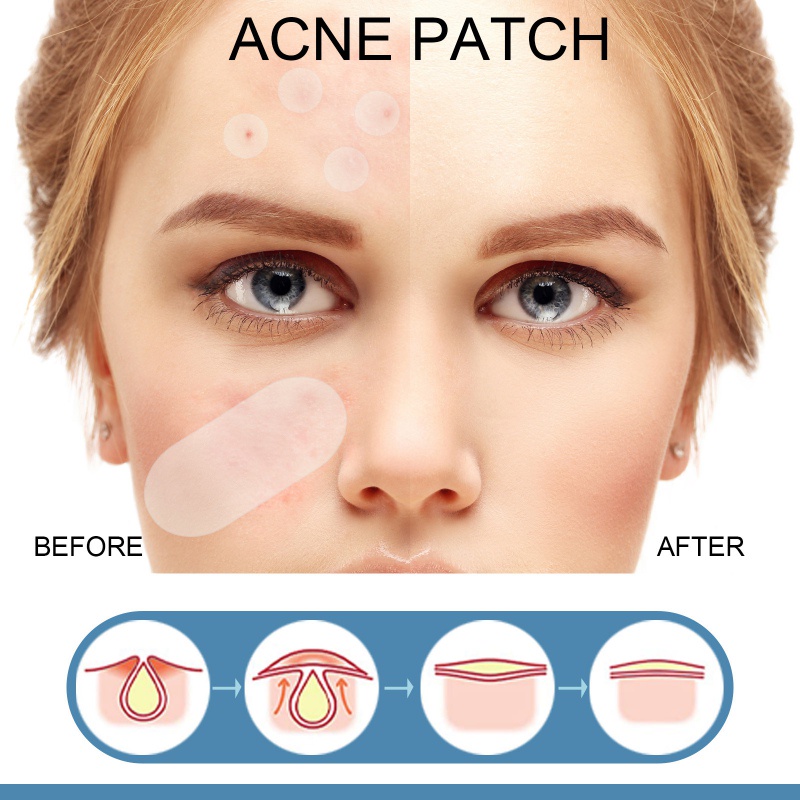 Set 80 Miếng Dán Mụn Hydrocolloid Vô Hình Tiện Dụng