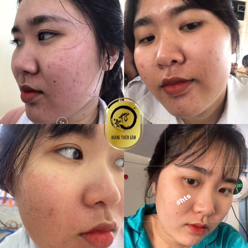 Combo Hoàng Thiên Sâm truyền thống sạch mụn thâm .