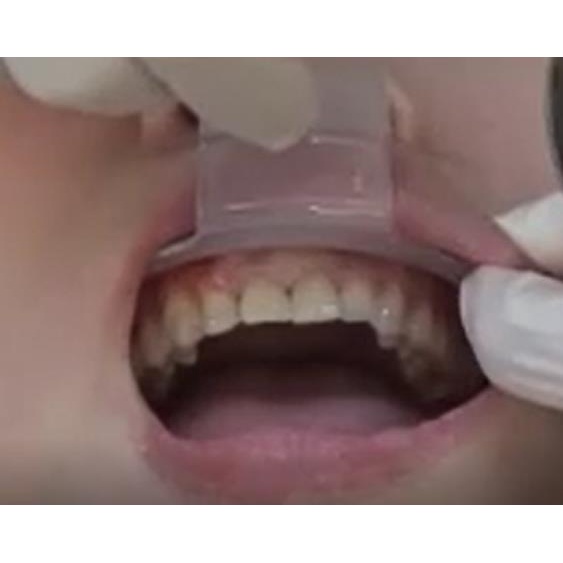 Dụng cụ hỗ trợ há miệng cho nha khoa