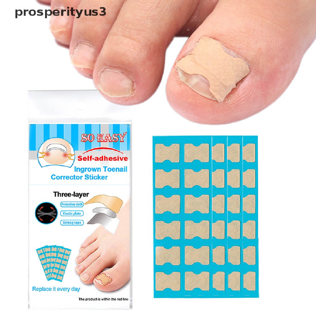 [prosperityus3] Ingrown Toenail Correction Tool Toe Nail Treatment Elastic Patch Sticker Clip [new]