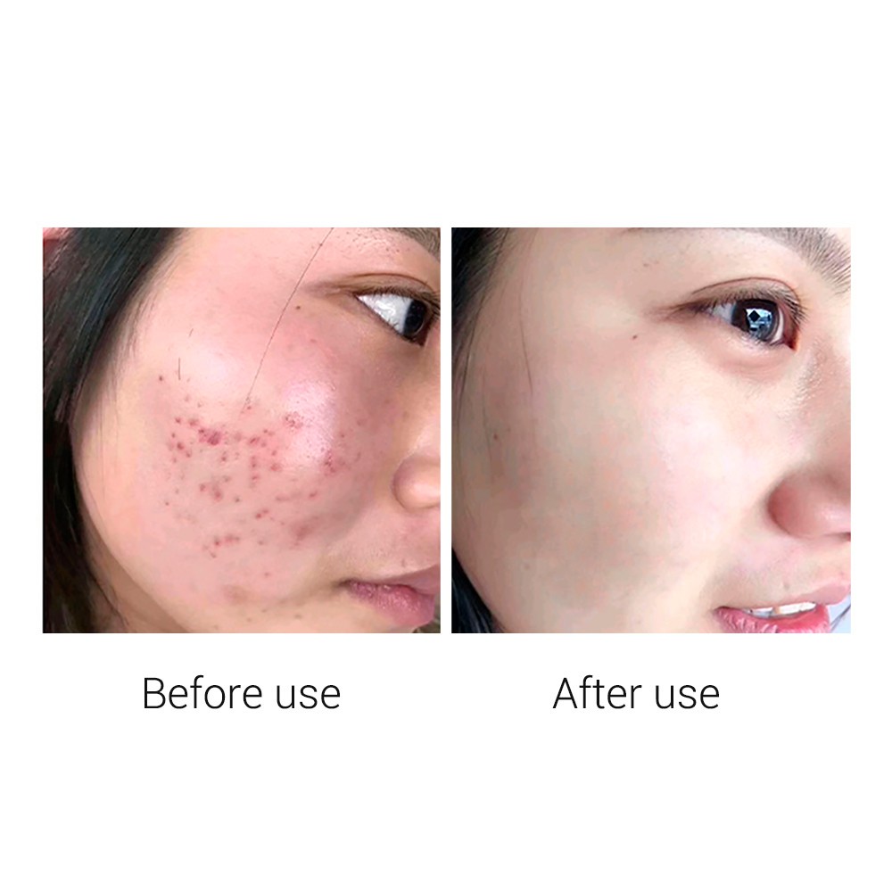 Mặt nạ Breylee chứa Collagen Vitamin C Retinol chuyên dụng làm trắng da hỗ trợ giảm mụn 25ml