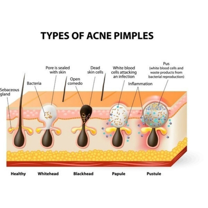 Miếng dán lột mụn đầu đen làm sạch lỗ chân lông tiện dụng | BigBuy360 - bigbuy360.vn