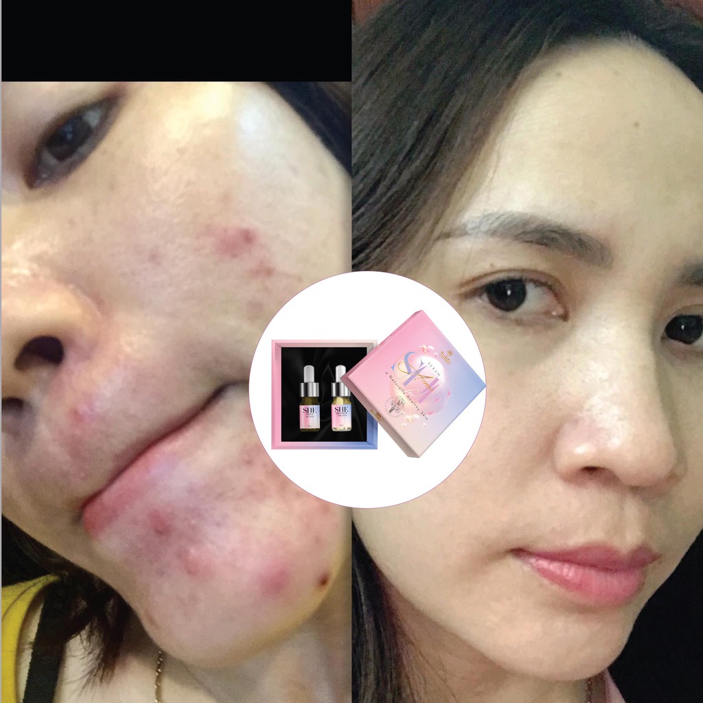 Combo Sạch mụn Skill Acnes 💥FREESHIP💥+ Treatment Collagen - Da khoẻ, Căng bóng, Trắng sáng + Tặng 5 mặt nạ dưỡng ẩm 30K | BigBuy360 - bigbuy360.vn