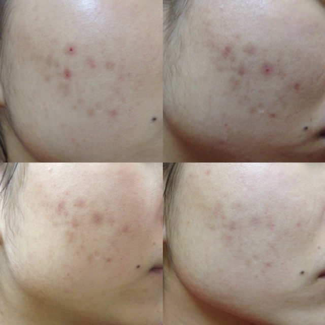 [Nội Địa Hàn] Bộ Loại Bỏ Mụn Ngừa Thâm Lành Sẹo ZYMOGEN Houttuynia Cordata Ferment Serum và Centella Cream | BigBuy360 - bigbuy360.vn