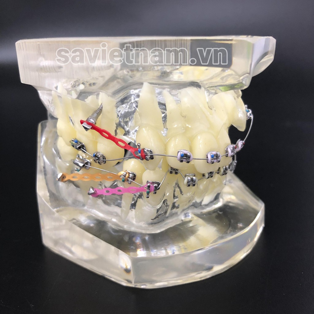 Mô hình mẫu hàm tư vấn chỉnh nha/ niềng năng đầy đủ mắc cài, dây cung, khí cụ - Mô hình răng nha khoa