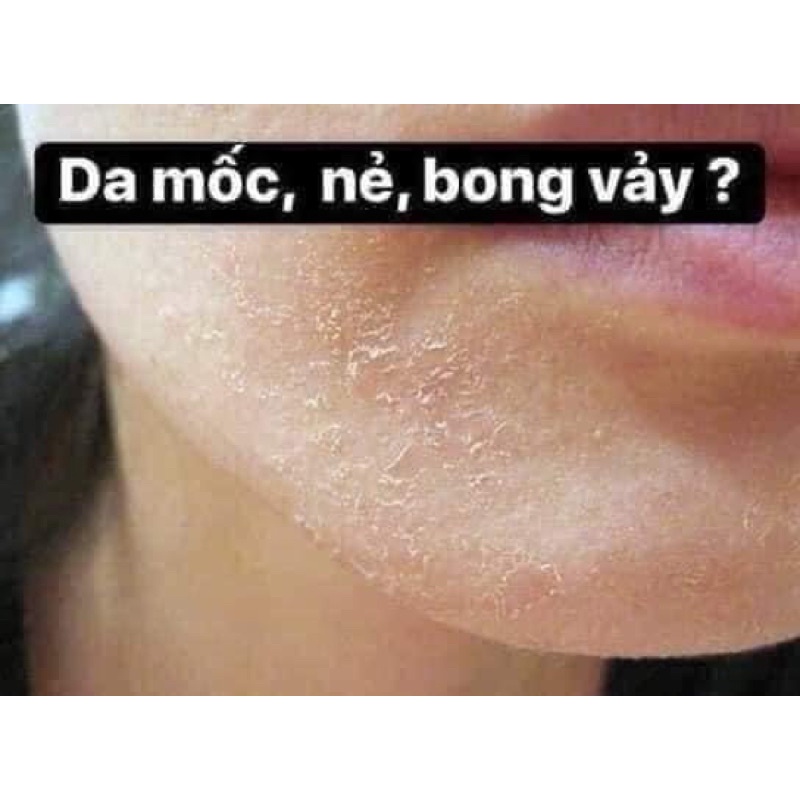 Kem nẻ của viện bỏng quốc gia