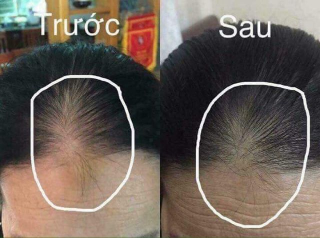 THUỐC XỊT MỌC TÓC Hair tonic