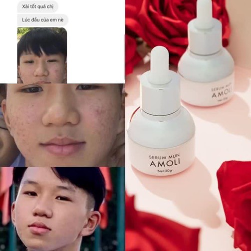 Serum AMOLISKIN - ĐIỀU TRỊ MỤN TẬN GỐC | BigBuy360 - bigbuy360.vn