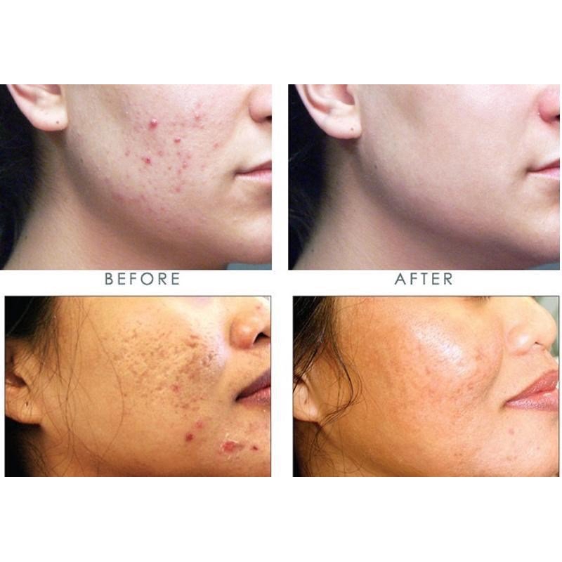 Tinh dầu tràm Tea Tree Oil The Body Shop | BigBuy360 - bigbuy360.vn