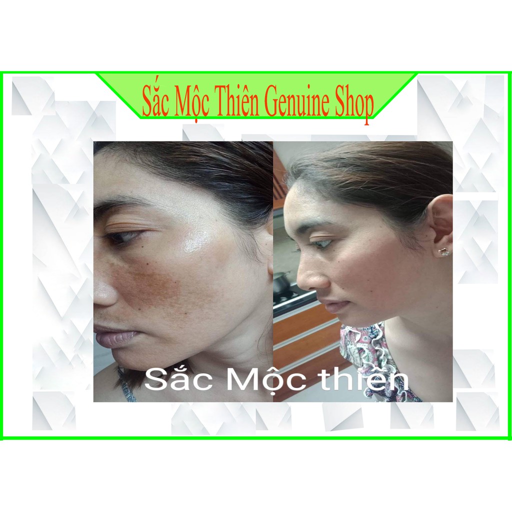 Tái Tạo Sắc Mộc Thiên -Làm bay  mụn , nám , tàn nhang- Cam kết hoàn tiền 100% nếu không hiệu quả . | BigBuy360 - bigbuy360.vn