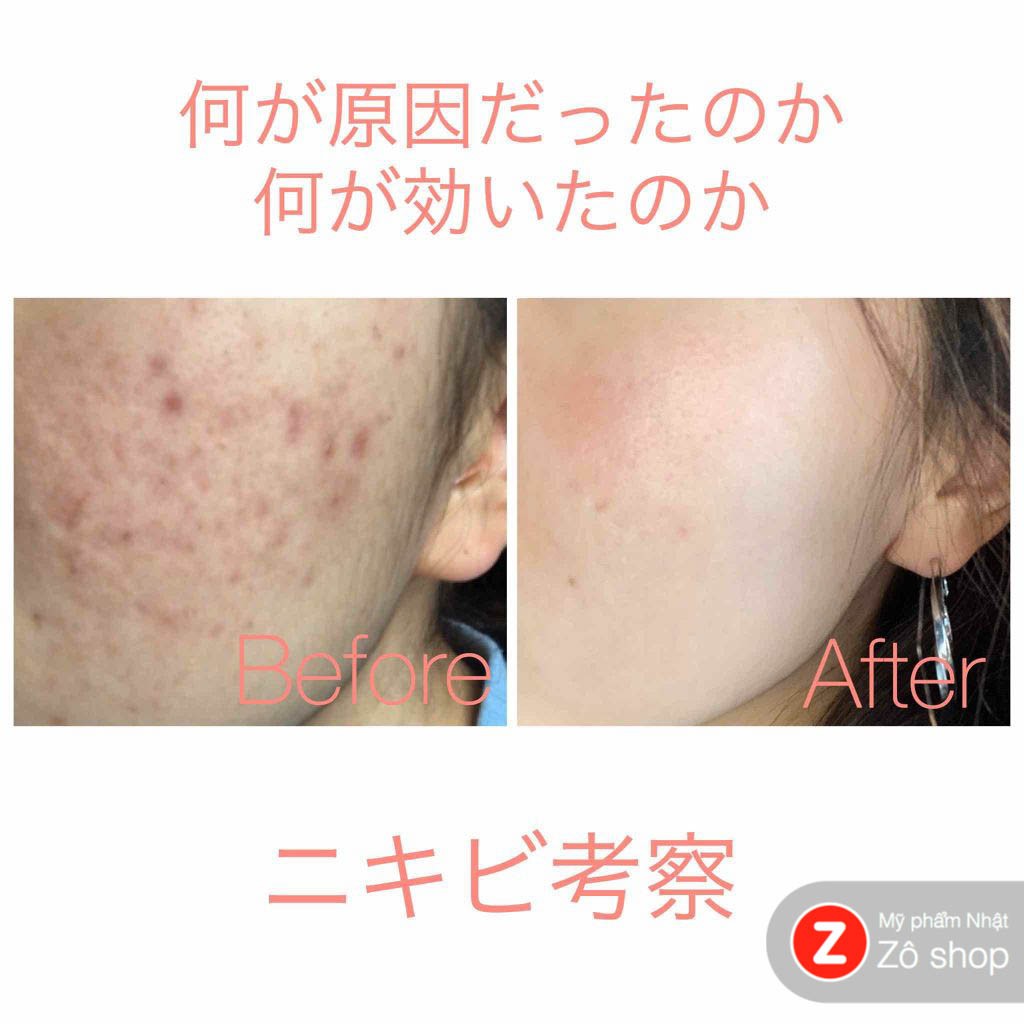 Kem Pair Acne Cream giảm mụn đỏ, mụn viêm sưng, mụn bọc, mụn nang cứng - đủ size | BigBuy360 - bigbuy360.vn