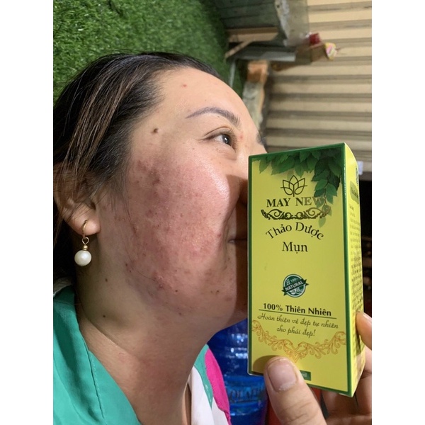 Serum thảo dược mụn may new tái tạo da