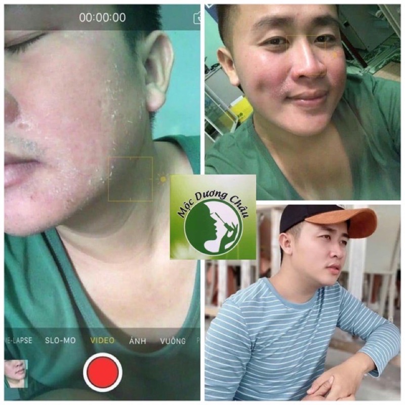 TÁI TẠO DA MỘC DƯƠNG CHÂU