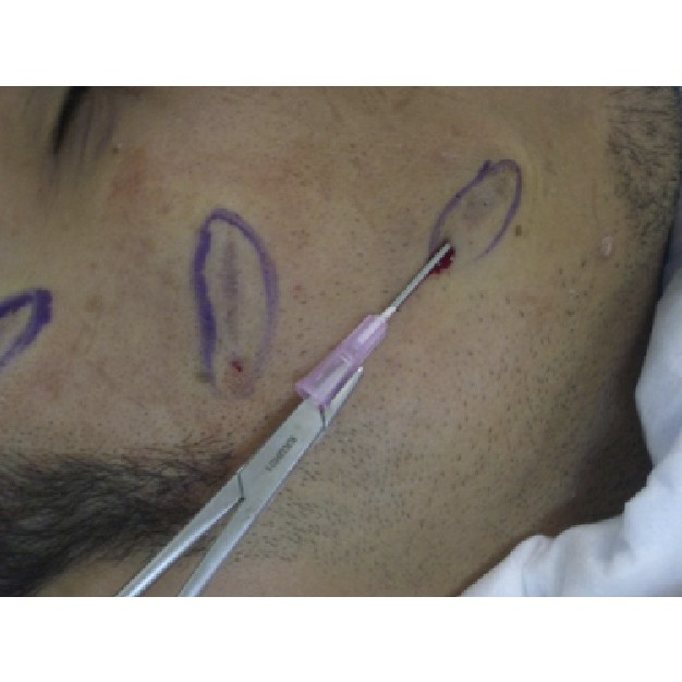 Kim Nokor 18G tách đáy sẹo rỗ có hướng dẫn với prp hàng nhập khẩu