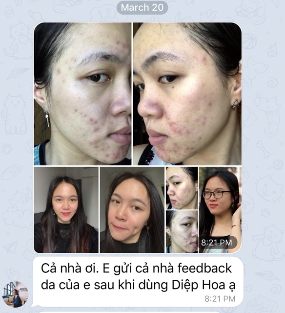 SERUM OGANA trị mụn