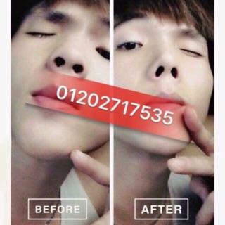 Sụn nâng mũi hàn quốc Nose secret chính hãng