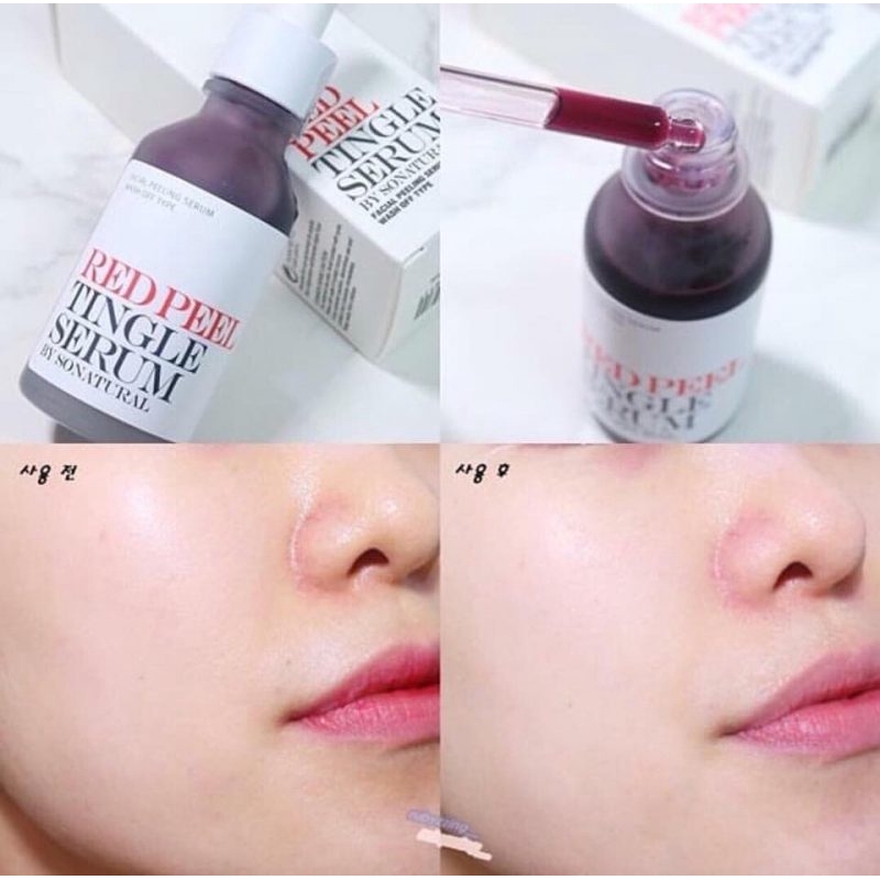 Tinh chất thay da sinh học Red Peel Tingle Serum | BigBuy360 - bigbuy360.vn