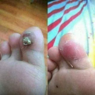 Trị mụn cóc mụn cơm