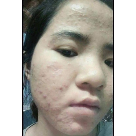 SERUM MỤN DETOX,DOCTOR QUEEN  GIÚP LÀN DA TRỞ NÊN MỊN, TRẮNG SÁNG, KHÔNG CÒN LO VỀ MỤN TRÊN DA MẶT