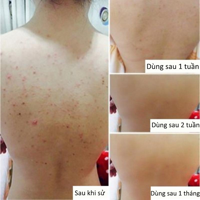 Sữa tắm loại bỏ mụn sữa tắm trắng da 260ml giúp giải quyết tình trạng da khô ngứa kháng khuẩn khử mùi hôi