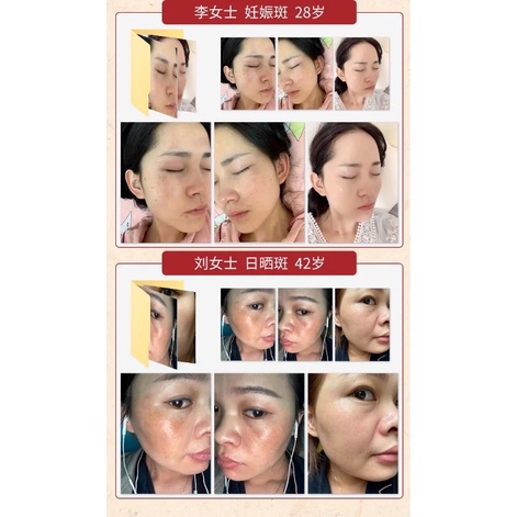 Tinh chất Trắng Da mờ thâm, làm sáng da, mờ vết nám, giúp da trắng sáng, mờ thâm và đều màu.