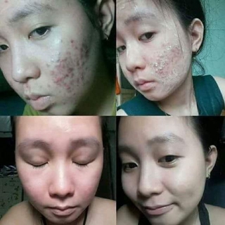 Thảo dược tái tạo da