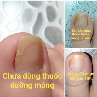 Dung Dịch Nấm Móng ,Phục Hồi Móng Hư Tổn (1 chai)