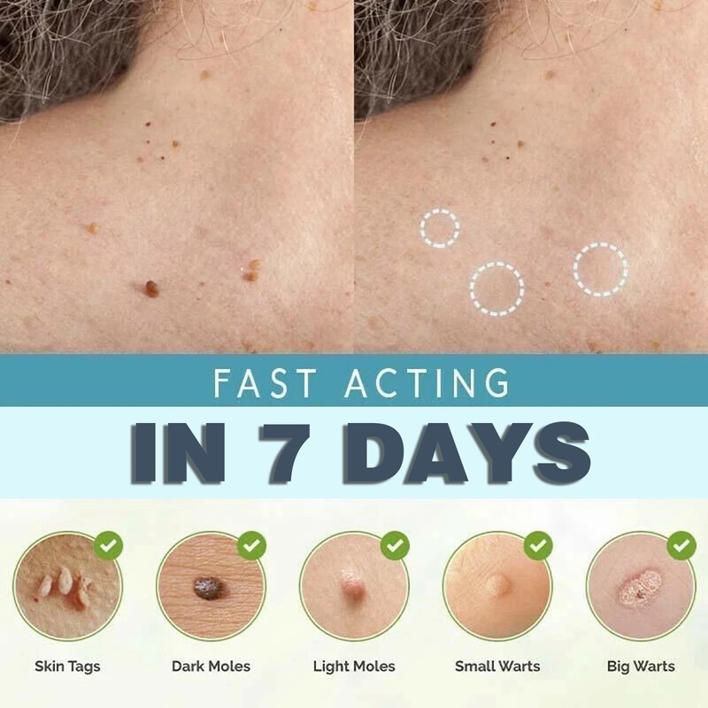 Bộ 2 Kẹp Loại Bỏ Mụn Trứng Cá / Vết Thâm Tức Thì Tiện Dụng Cho Mọi Lứa Tuổi