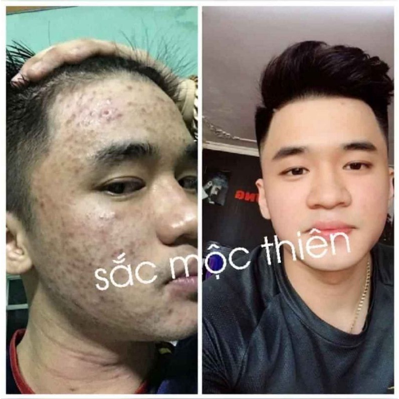 Tái tạo da cao cấp Sắc Mộc Thiên- Hỗ trợ cải thiện mụn- Nám- Tàn nhang- Sẹo | BigBuy360 - bigbuy360.vn