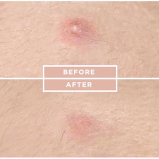 Miếng Dán Mụn Cosrx Acne Pimple Master Patch
