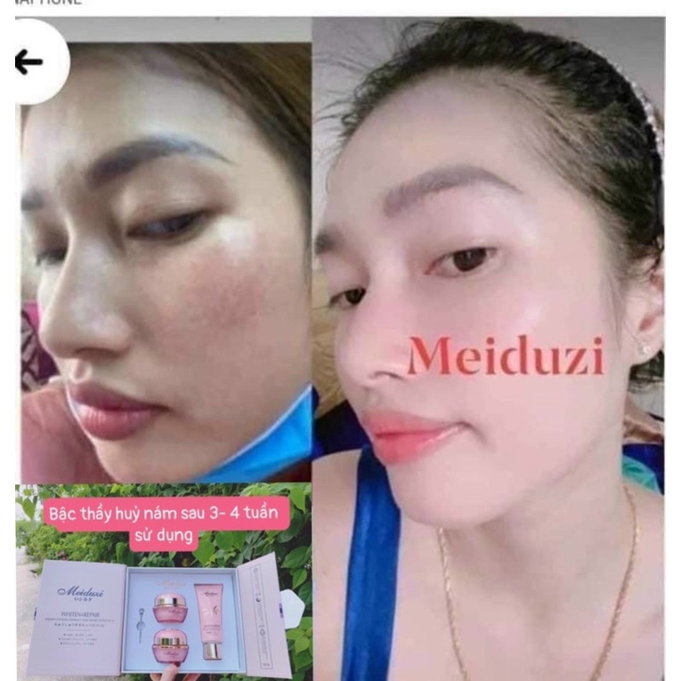 Bộ kem MEIDUZi vip Hồng trắng da mờ nám mẫu nâng cấp