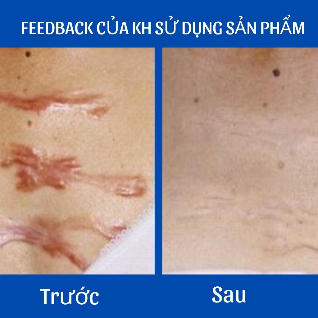 Serum Sẹo Lồi - Sẹo Lõm - Sẹo Rỗ Lâu Năm V3