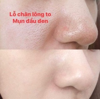 KEM THU NHỎ LỖ CHÂN LÔNG SQS
