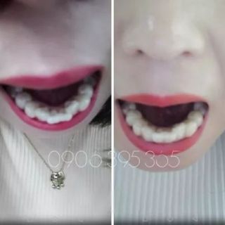 (A1+A2+A3) DỤNG CỤ NIỀNG RĂNG CHO NGƯỜI LỚN