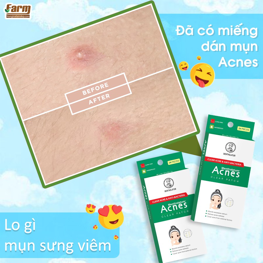 Miếng Dán Mụn Acnes Clear Patch