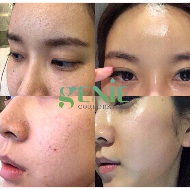 SERUM HA VOLUME SKIN UP GENIE tế bào gốc vạn năng.