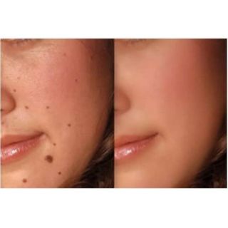Gel chấm tàn nhang,nốt ruồi,thịt dư