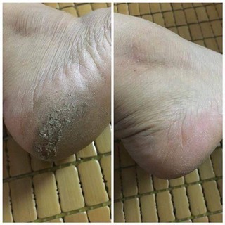Dụng cụ gọt da chết gót chân Balea